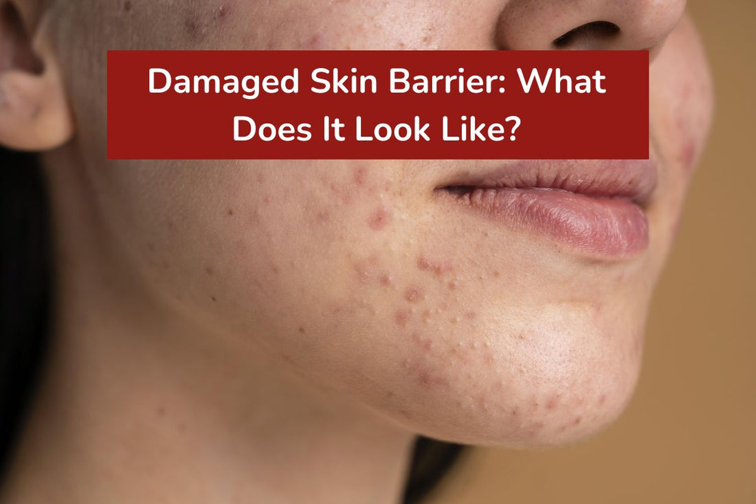 Damaged Skin Barrier: What Does It Look Like