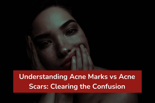 Understanding Acne Marks vs Acne Scars: Clearing the Confusion
