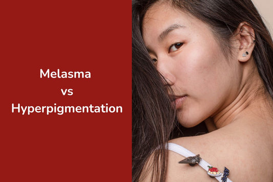 Melasma vs Hyperpigmentation